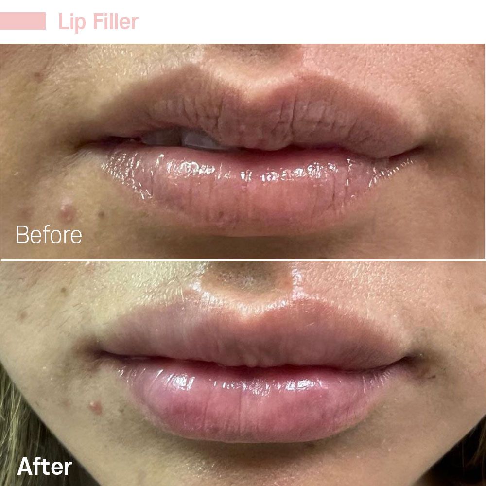 A before and after photo of a woman 's lips with lip filler.