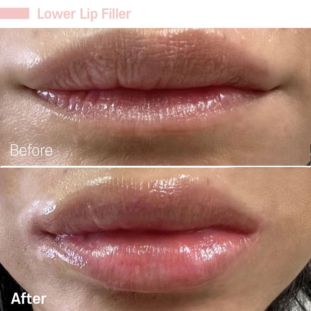 A before and after photo of a woman 's lips with lower lip filler.