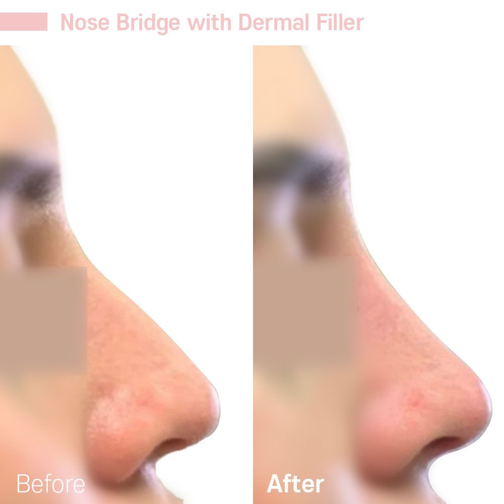 A before and after picture of a nose bridge with dermal filler.