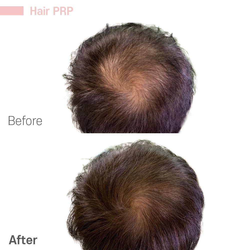 A before and after picture of a person 's hair