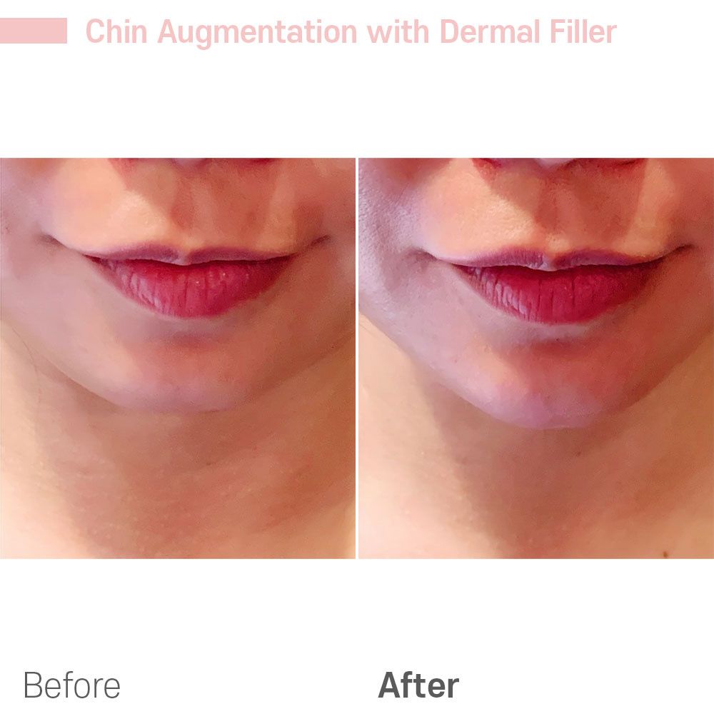 A before and after photo of a woman 's chin with dermal filler.