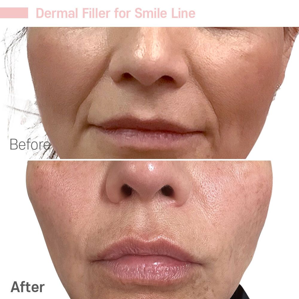 A before and after photo of a woman 's face with dermal filler for smile line.