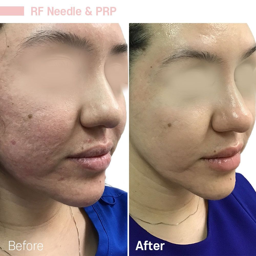 A woman 's face before and after rf needle and prp treatments
