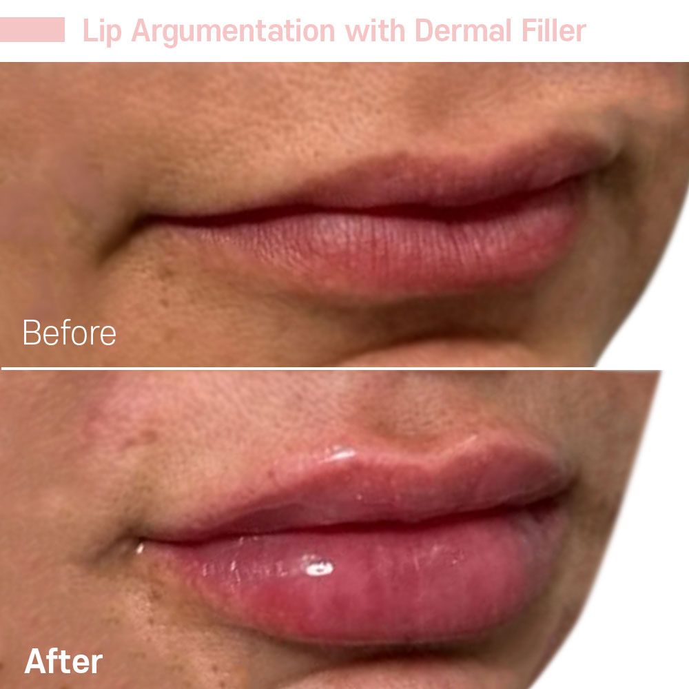 A before and after photo of a woman 's lips with the caption lip argumentation with dermal filler