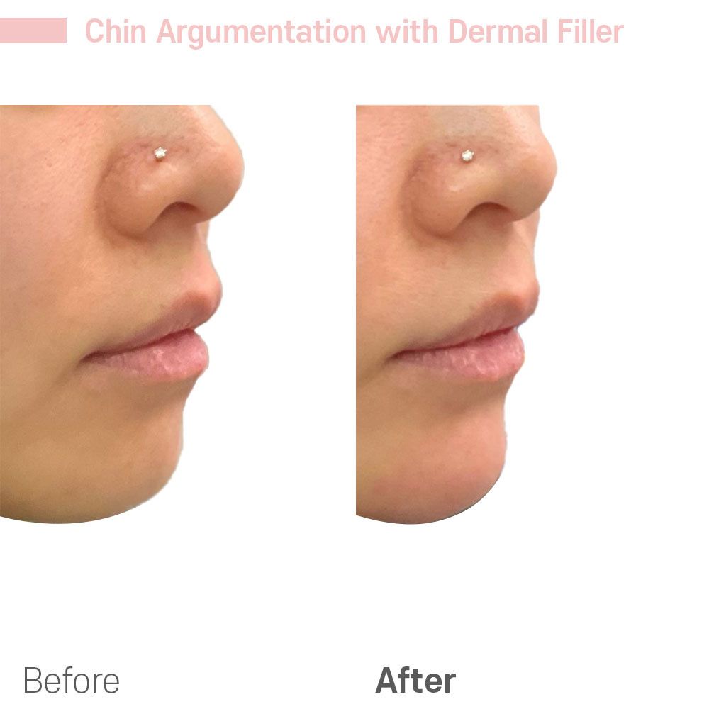A before and after picture of a woman 's chin with dermal filler