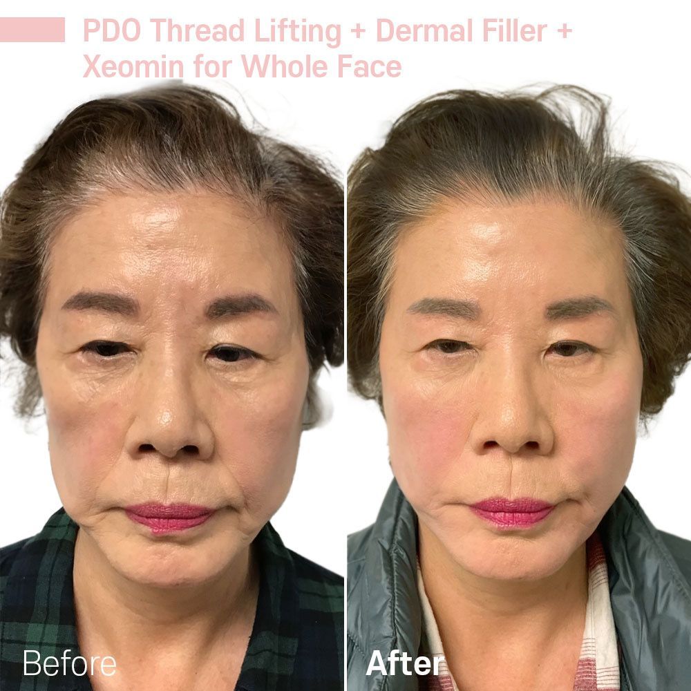 A before and after photo of a woman 's face.