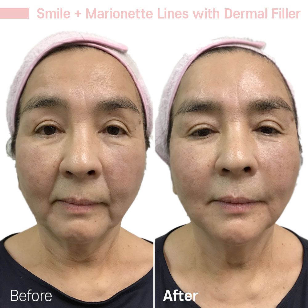 A before and after photo of a woman with marionette lines with dermal filler