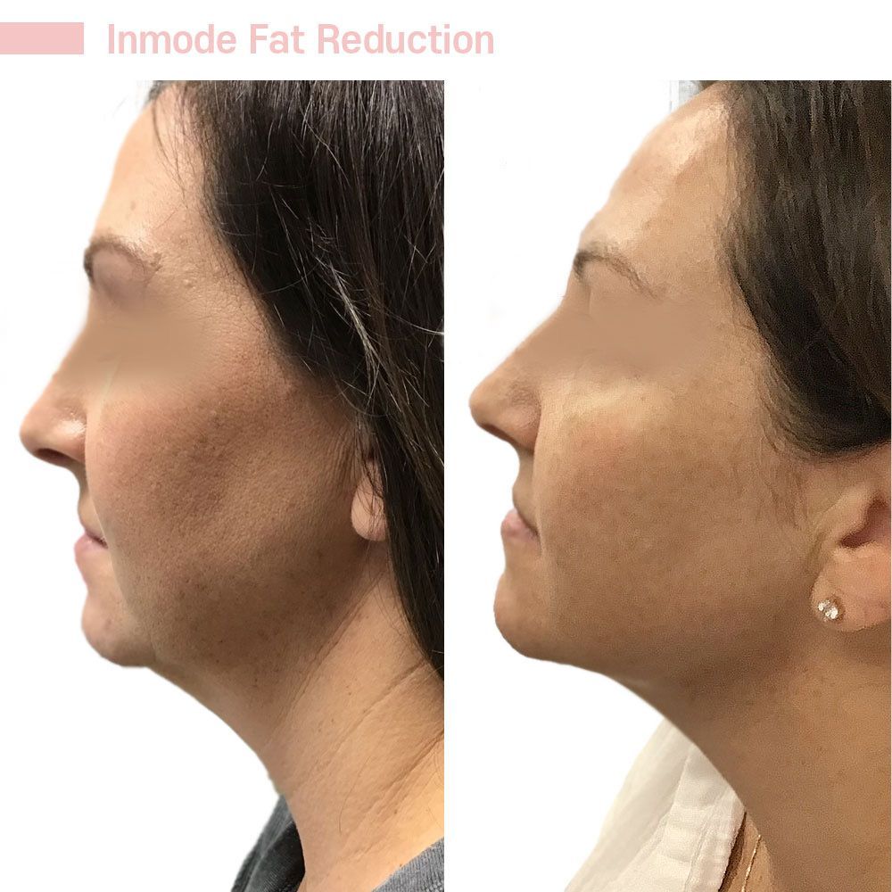 A before and after photo of a woman 's neck and face.