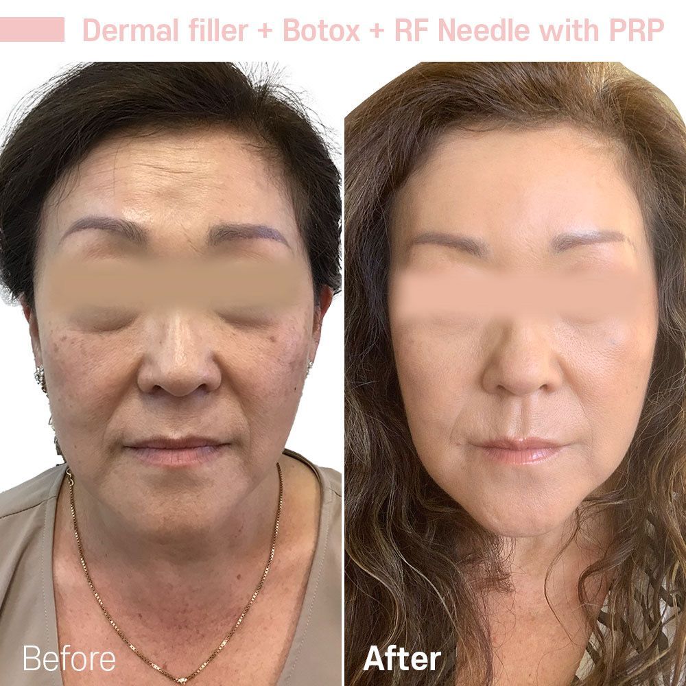 A before and after photo of a woman 's face.