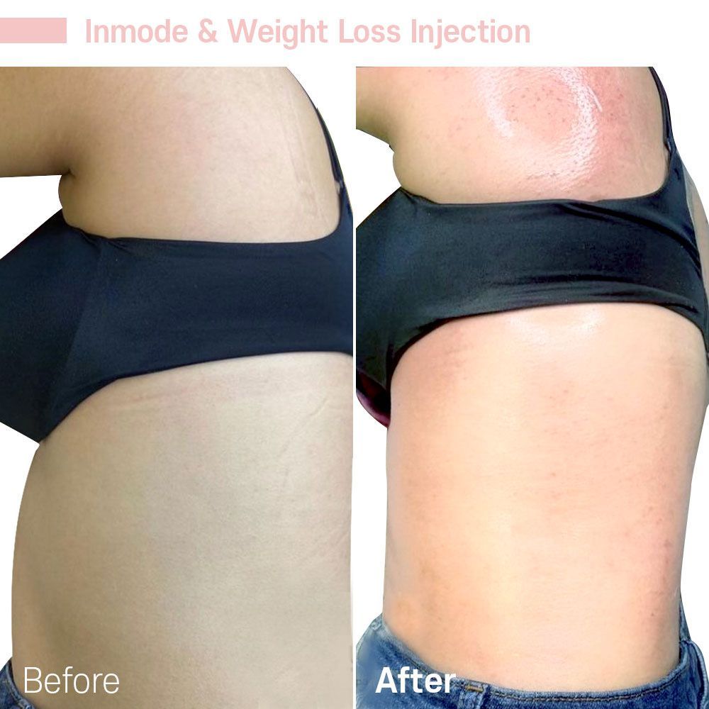 A picture of a woman 's torso before and after a weight loss injection