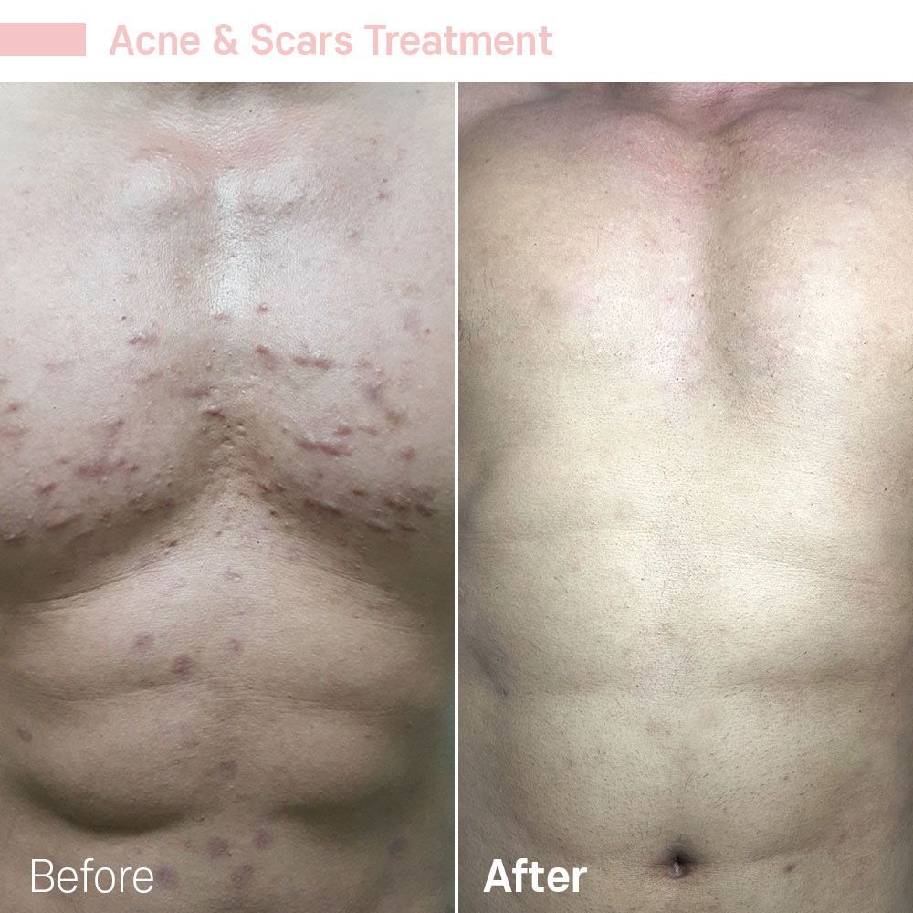 A man 's chest before and after acne and scars treatment.
