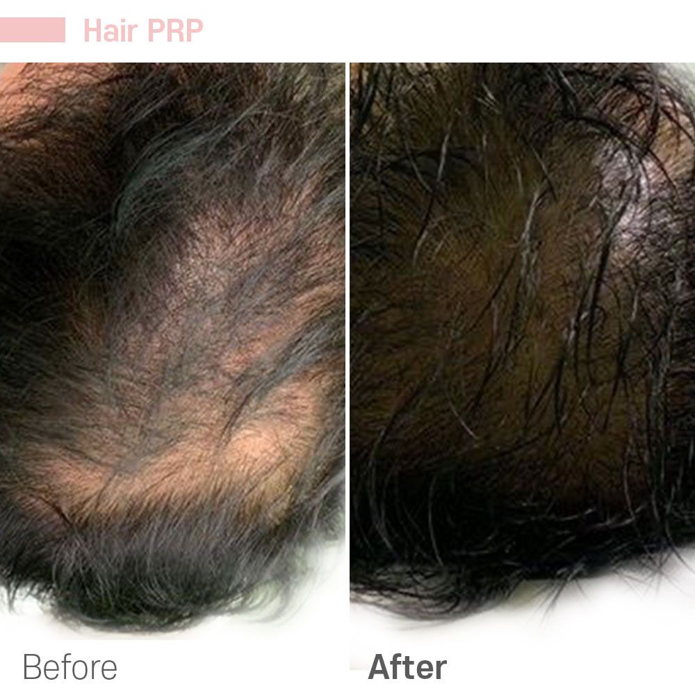 A before and after photo of a person 's hair.