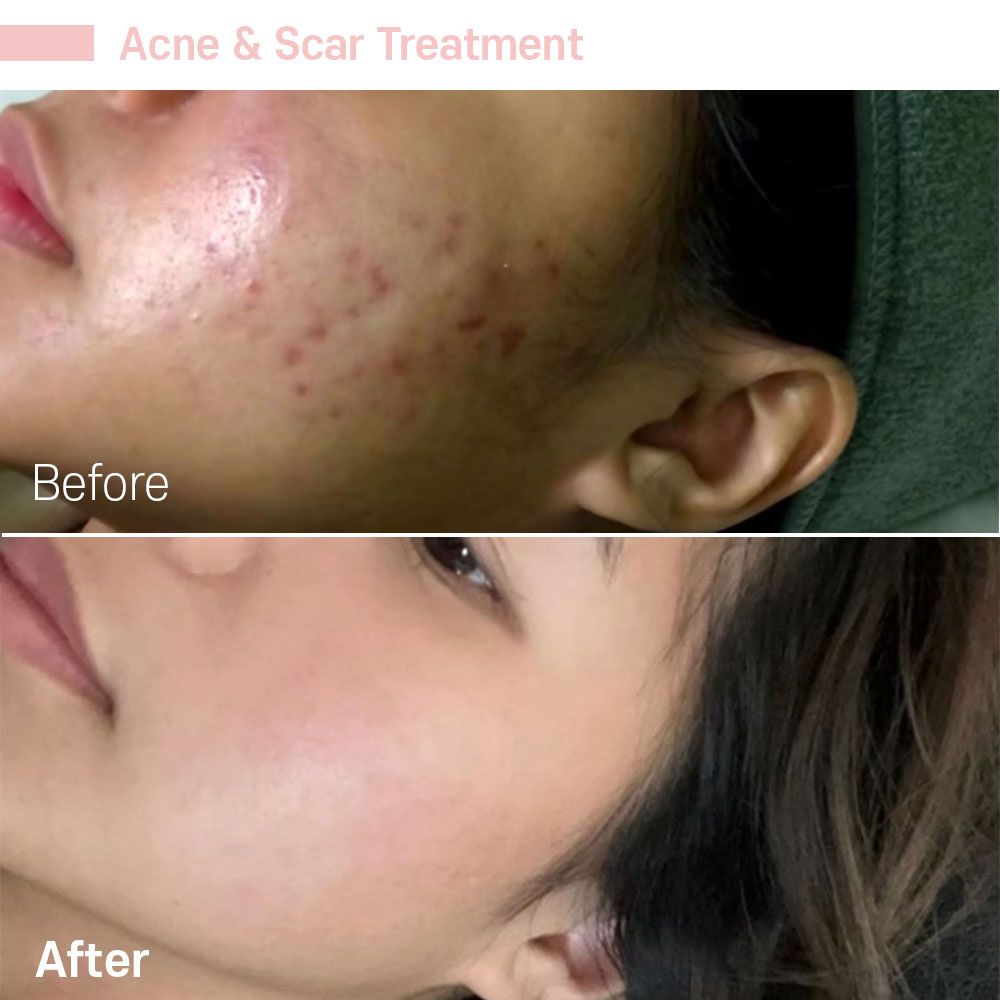 A woman 's face before and after acne and scar treatment