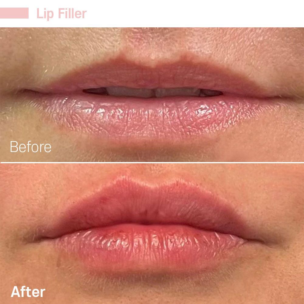 A before and after photo of a woman 's lips with lip filler.