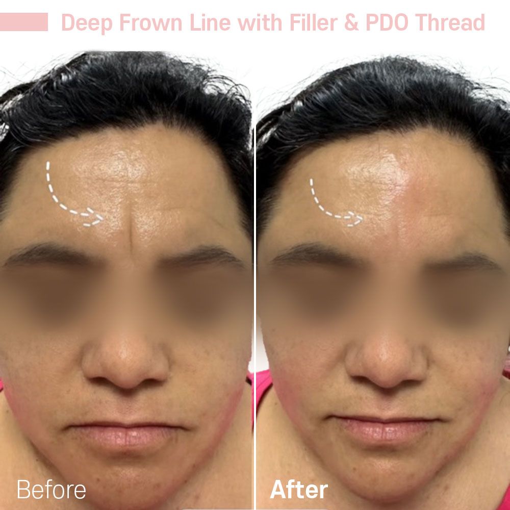 A before and after photo of a woman 's forehead with filler and pdo thread.