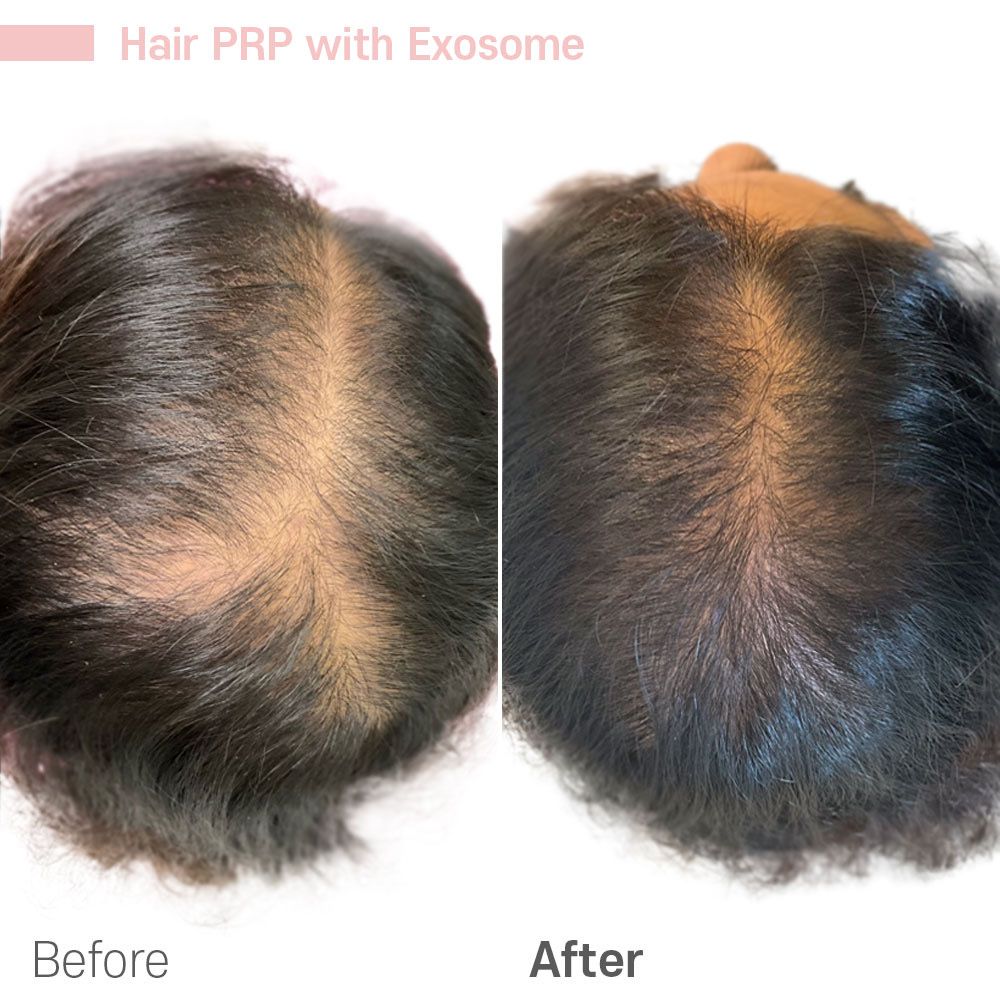 A before and after picture of hair prp with exosome