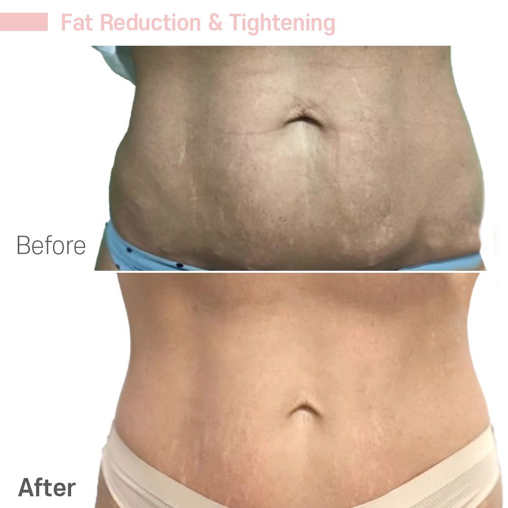 Weigh loss before and after