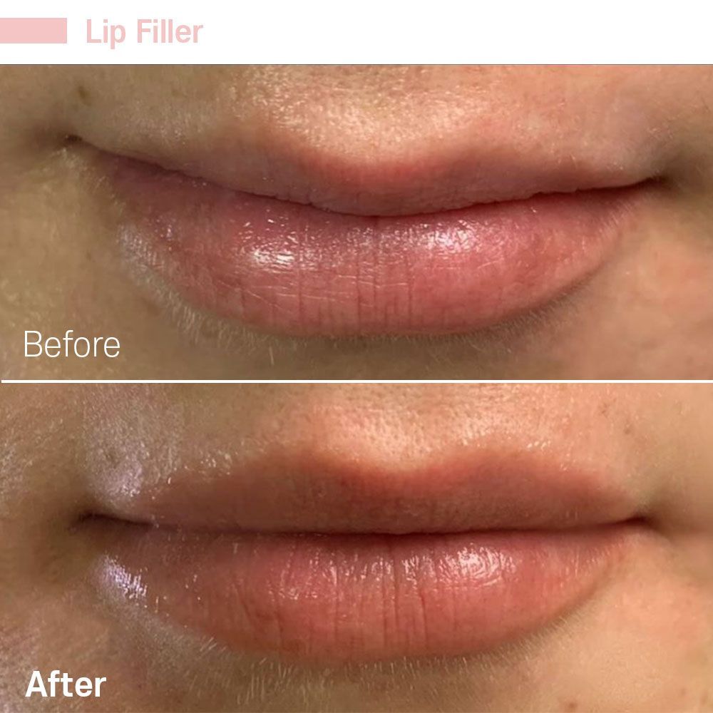 A before and after photo of a woman 's lips with lip filler.