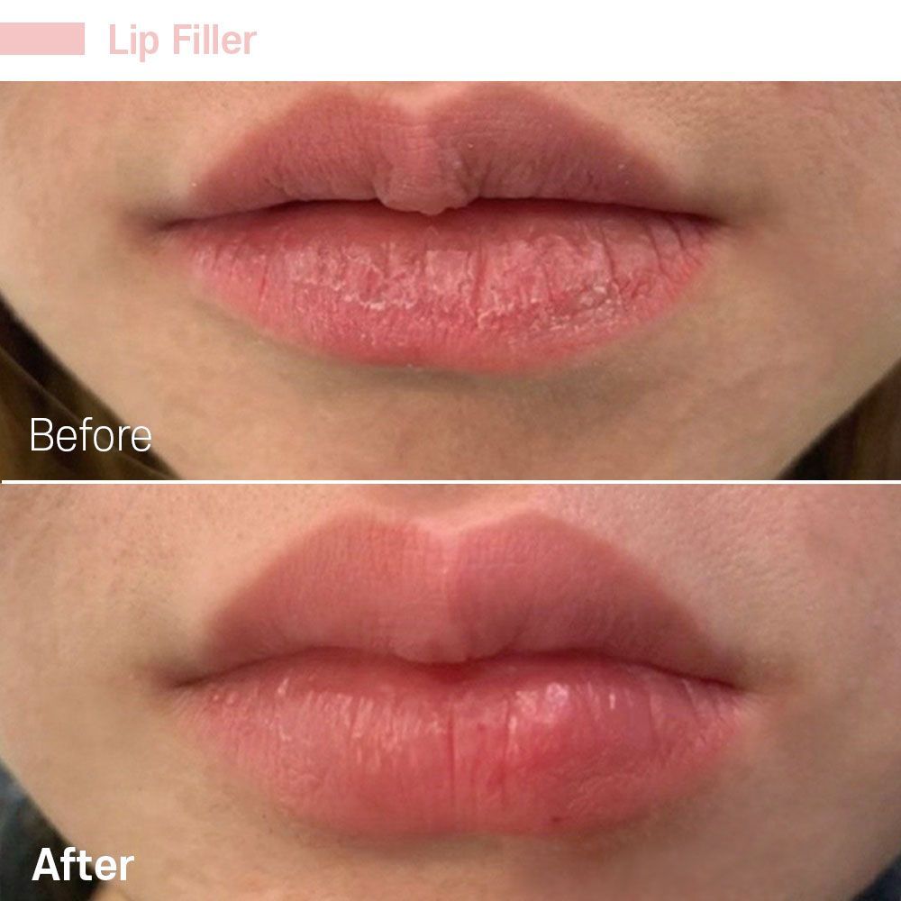 A before and after photo of a woman 's lips with lip filler.