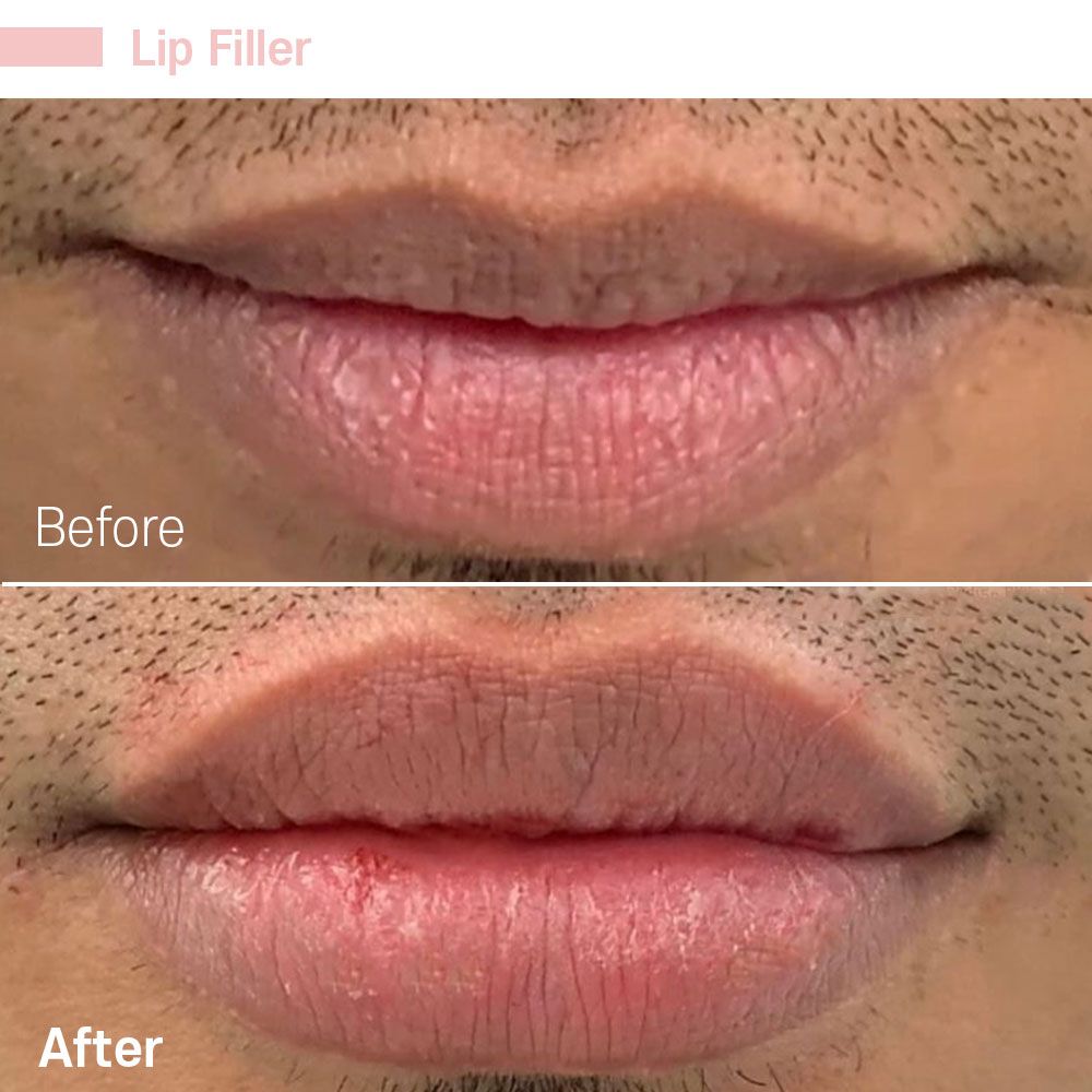A before and after photo of a man 's lips with lip filler.