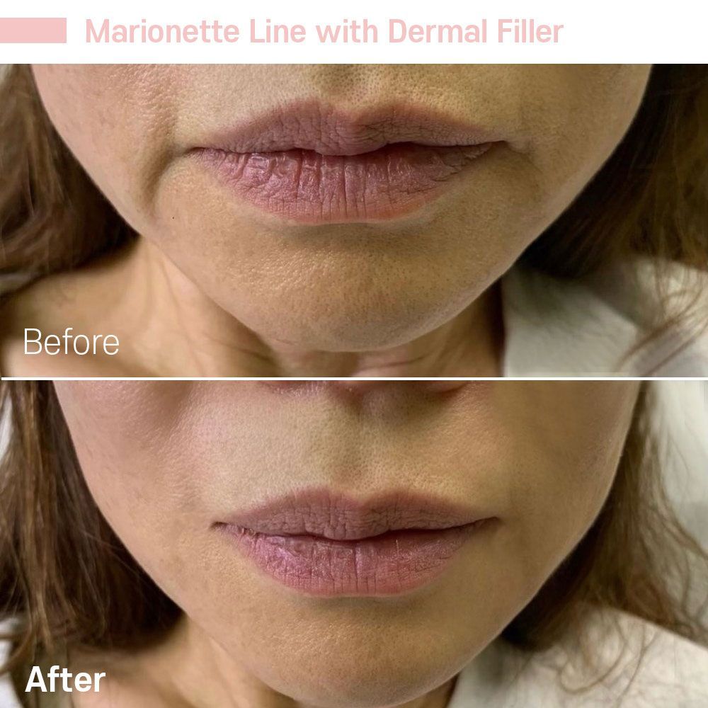 A before and after photo of a woman 's lips with dermal filler.