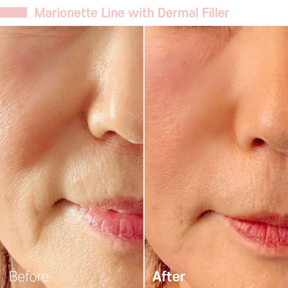 A before and after photo of a woman 's face with marionette line with dermal filler.