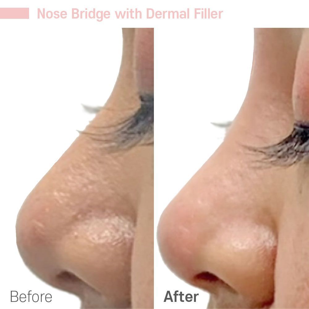 A before and after picture of a nose bridge with dermal filler.
