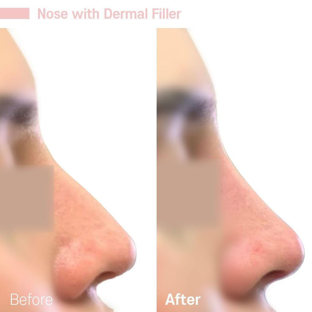 A before and after picture of a nose with dermal filler.