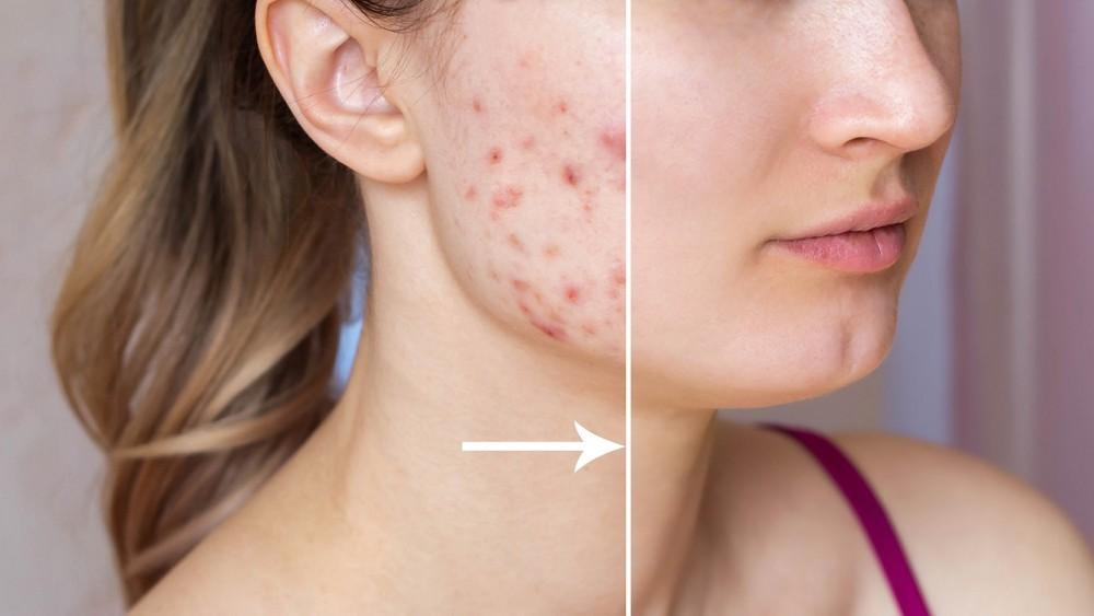 A before and after photo of a woman 's face with acne.