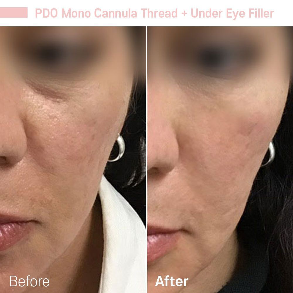 A before and after photo of a woman 's face.