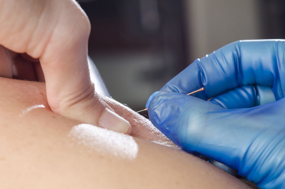 A Needle And Hands Of A Physiotherapist Providing Dry Needling — Dry Needling in Glenfield Park, NSW