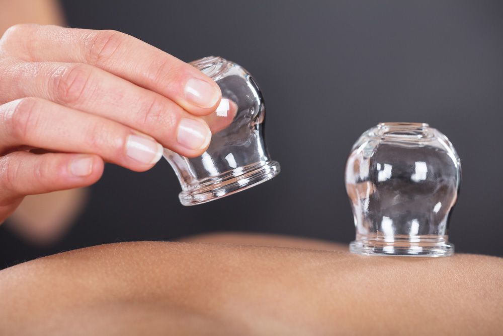 A Therapist Giving Cupping Treatment On Back — Master Your Journey in Glenfield Park, NSW
