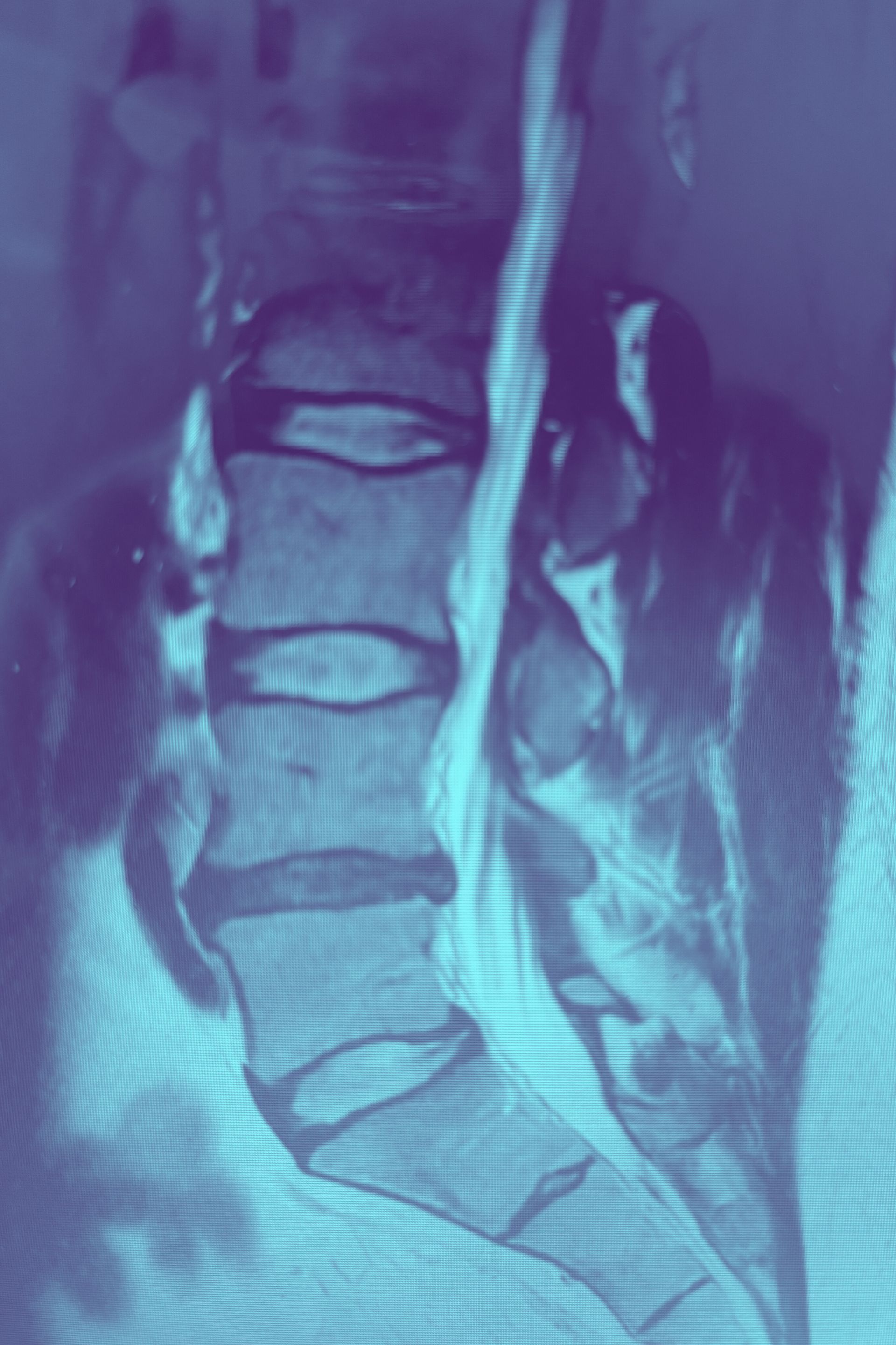 Hernia discal en corredor de trail 