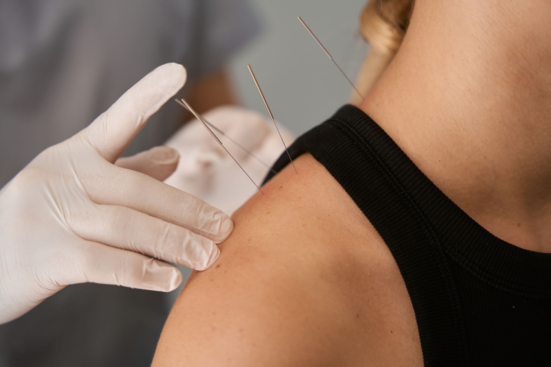 A person receiving acupuncture on their shoulder. A gloved hand places needles into the skin.