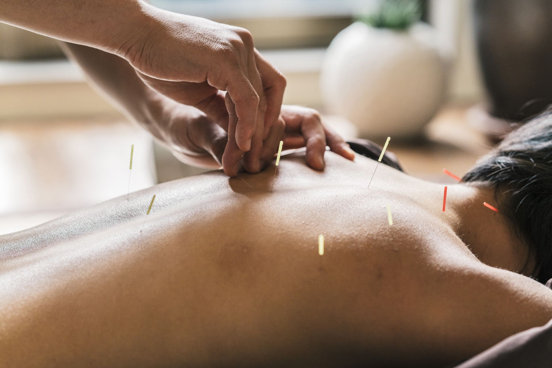 A person receiving acupuncture on their back, needles inserted along the spine. A hand inserts a needle.