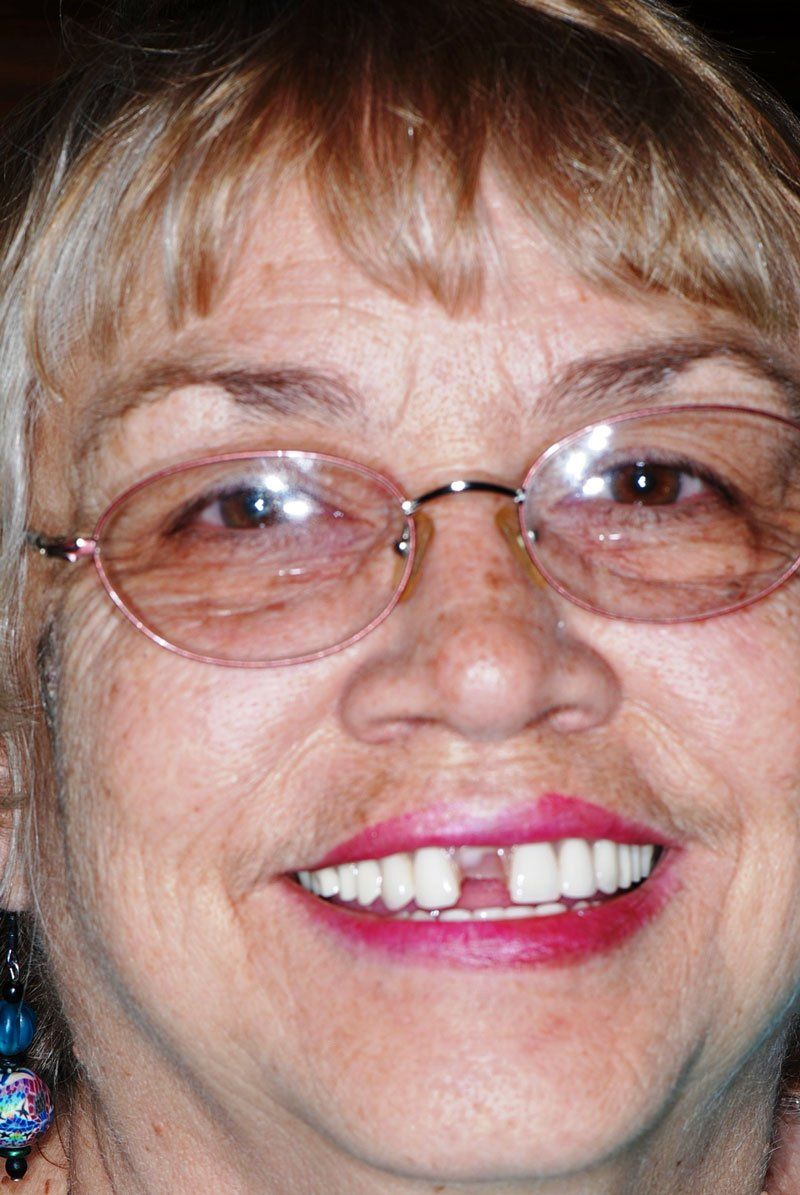 Denture Exam — Woman Smiling With Broken Teeth in Tucson, AZ