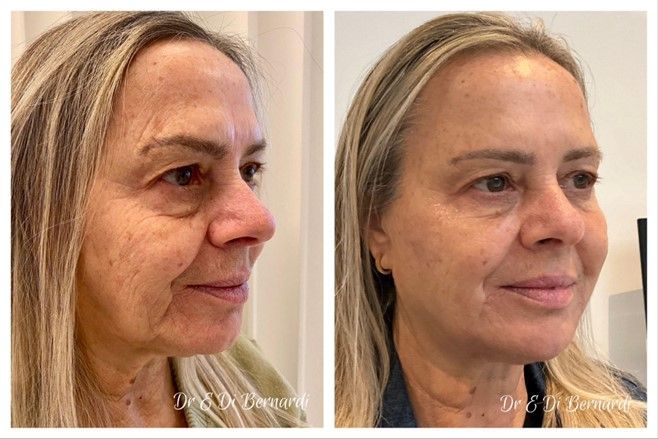 Before and after photos showcasing results of treatment at Hampstead Clinic - Deep lines removed with fillers