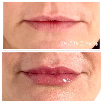 Before and after photos of lip enhancement, showcasing results at Hampstead Clinic