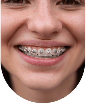 Woman with braces smiling, illustrating who can benefit from general orthodontics at Hampstead Clinic