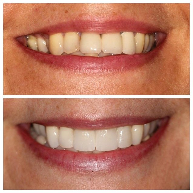 Before and after photos of porcelain crowns, showing treatment benefits at Hampstead Clinic