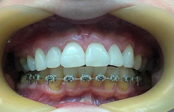 Close-up after photos of composite bonding veneers, showcasing smile enhancements at Hampstead Clinic