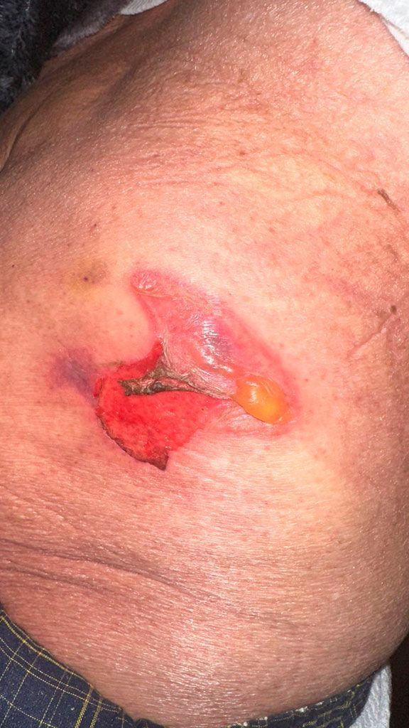 CLINICA DE LESIONES DERMICAS PROMEDICA  -  DIABETES