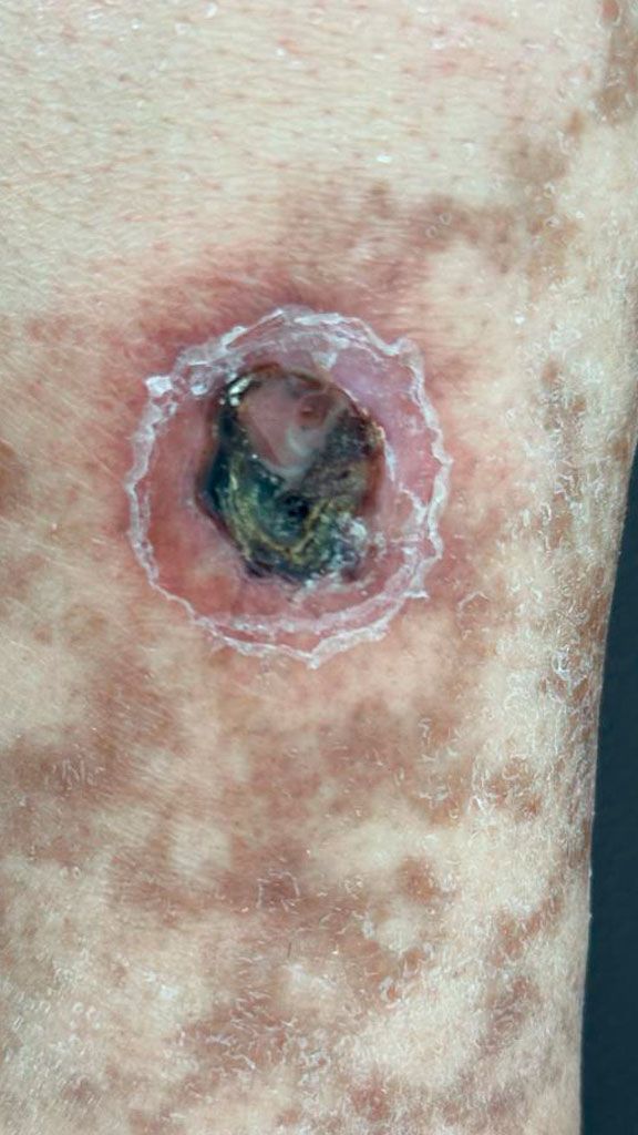 CLINICA DE LESIONES DERMICAS PROMEDICA  -  INFECCIONES