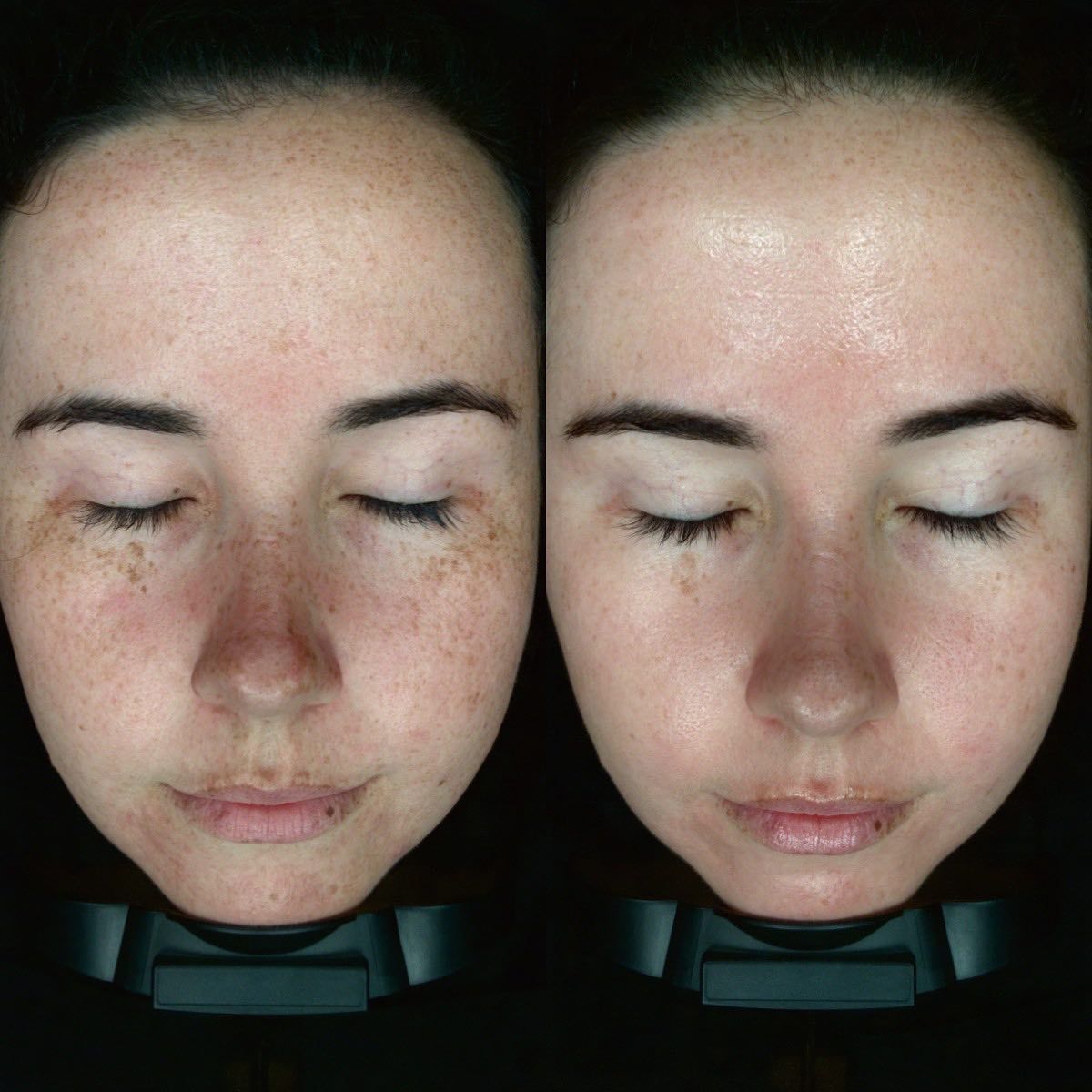 A Before And After Photo Of A Woman 's Face With Her Eyes Closed — Vanity Skin and Beauty Forster in Forster, NSW