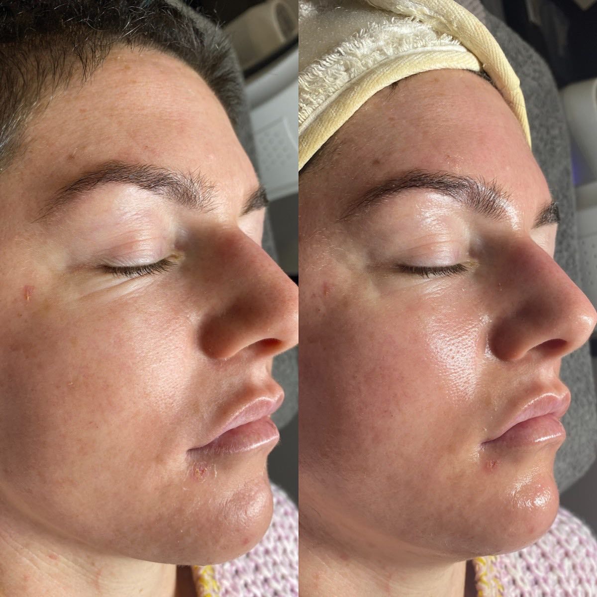 A Before And After Photo Of A Woman's Face With Her Eyes Closed — Vanity Skin and Beauty Forster in Forster, NSW