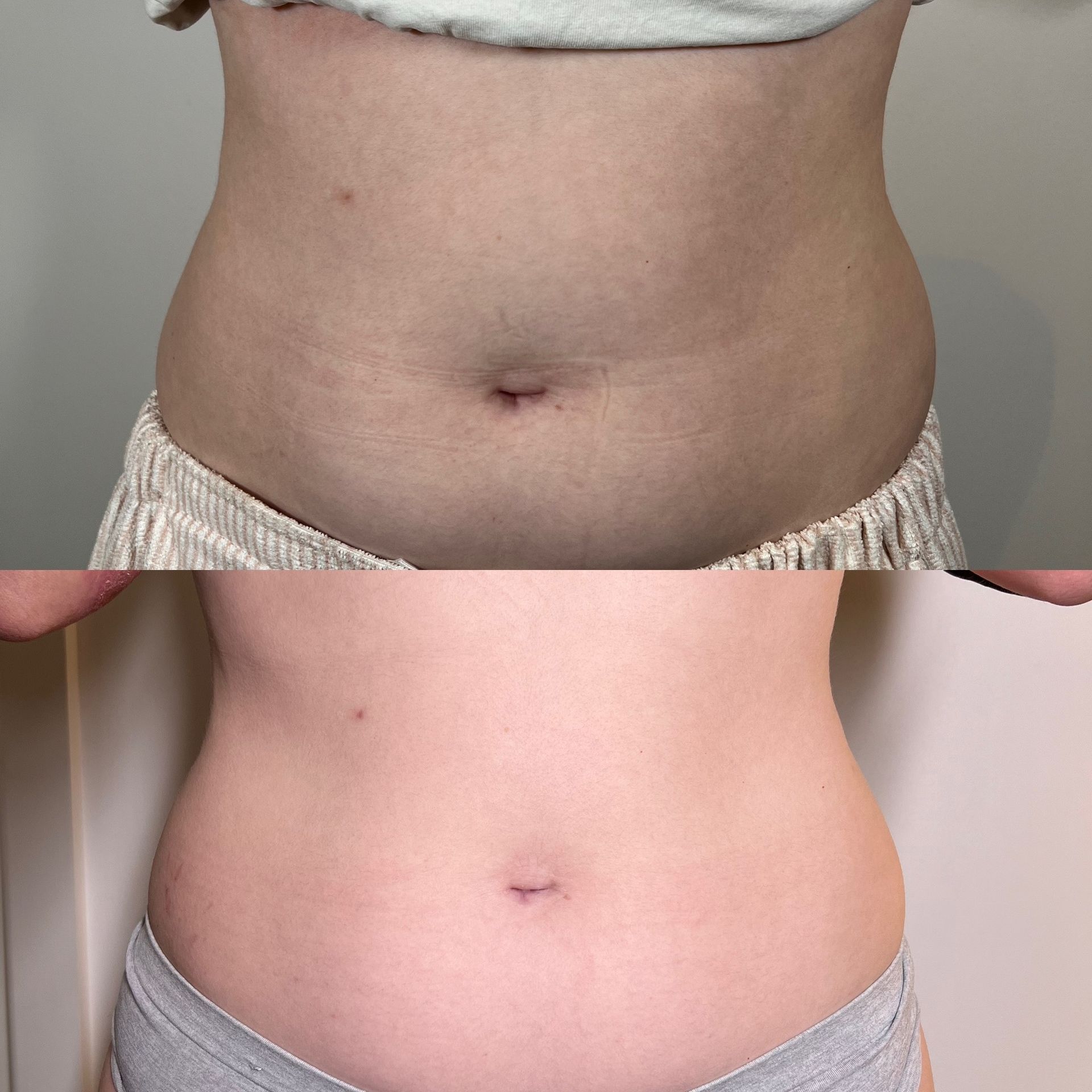 A Before And After Picture Of A Woman's Stomach — Vanity Skin and Beauty Forster in Forster, NSW