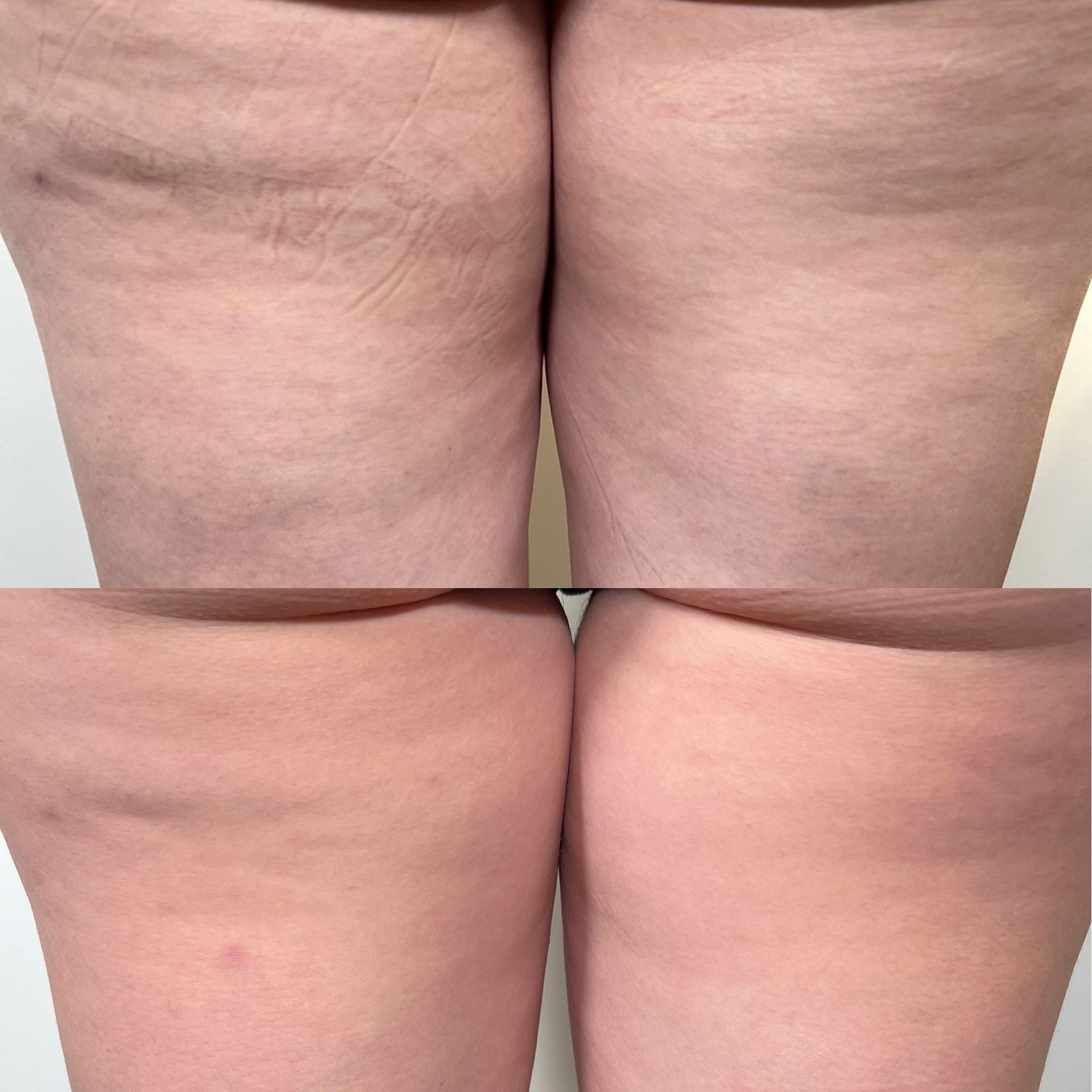 A Woman's Legs Are Shown Before And After A Treatment — Vanity Skin and Beauty Forster in Forster, NSW