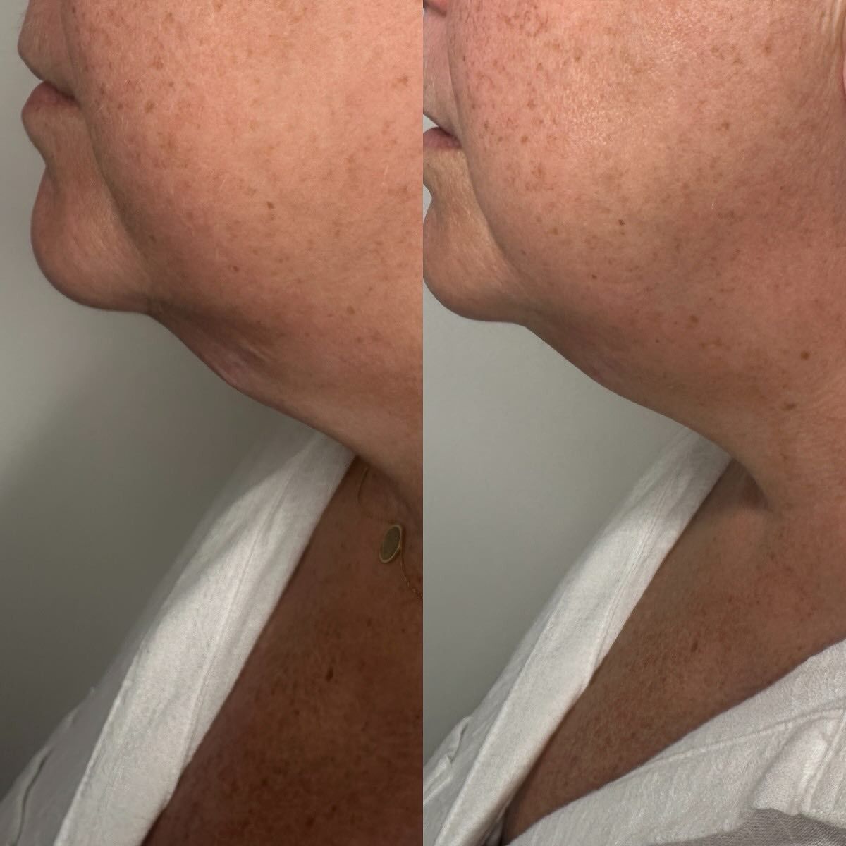Side-by-side Comparison: Before and After View of a Person's Neck — Vanity Skin and Beauty Forster in Forster, NSW