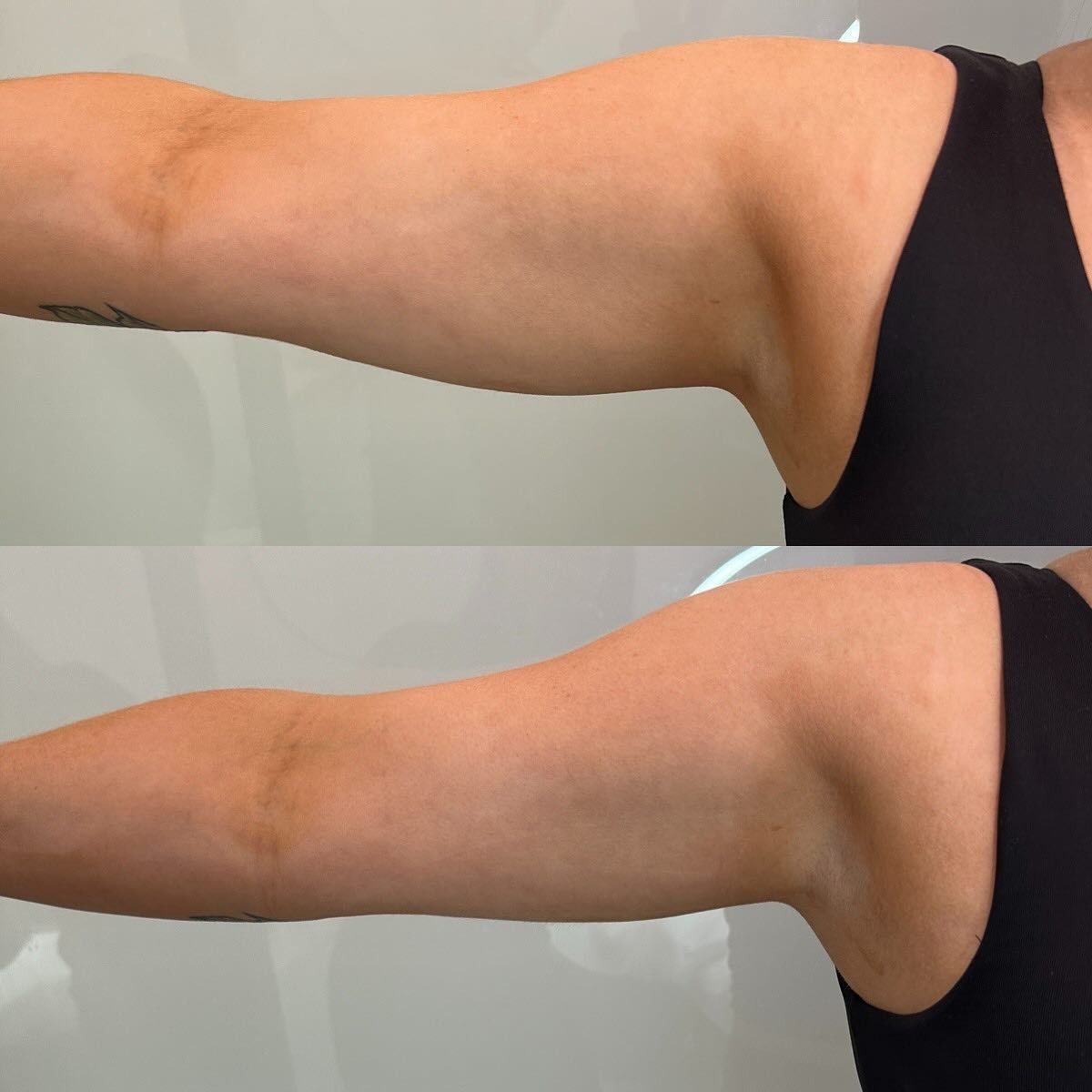 Two Photos of an Arm, Top Showing Loose Skin — Vanity Skin and Beauty Forster in Forster, NSW