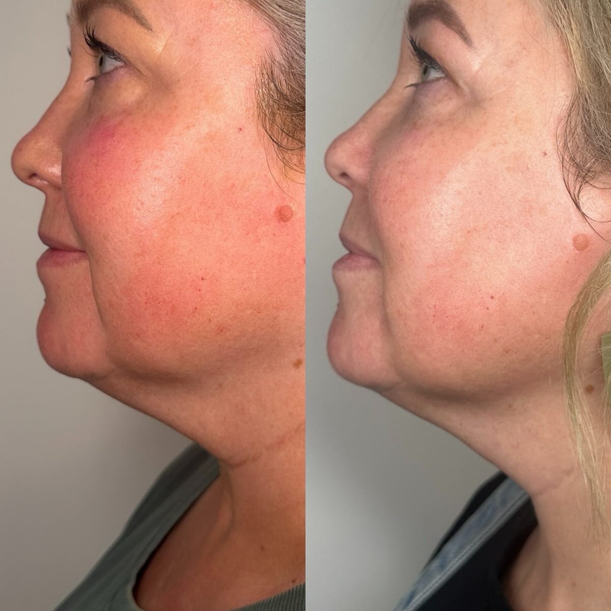 Before and After Photos of a Woman's Face and Neck — Vanity Skin and Beauty Forster in Forster, NSW